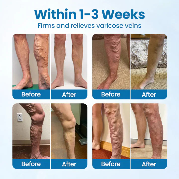 Nexisify® VeinGuard Herbal Spray-✅ Clinically proven to eliminate varicose veins in just 7 days!